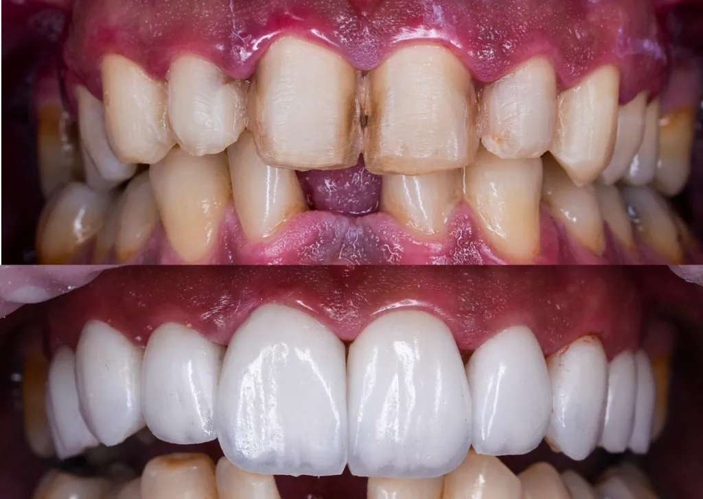 What to Know Before You Get Dental Veneers?